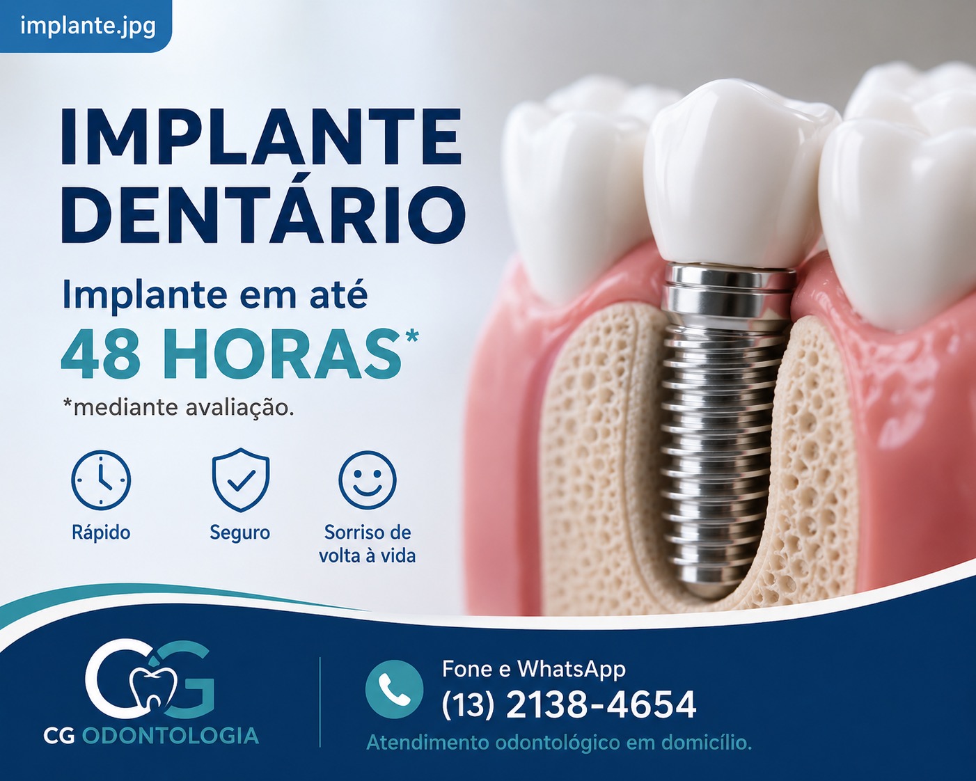 Implantes dentários